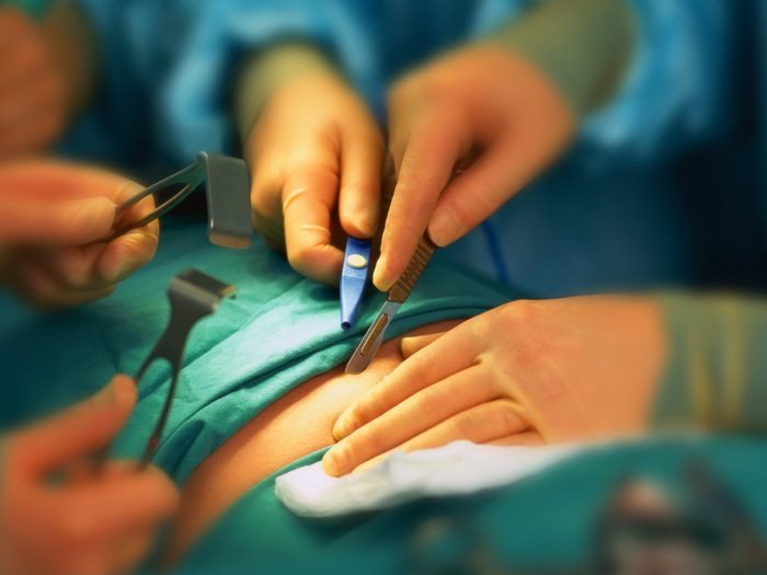  Apendicita acută: singura soluţie este intervenţia chirurgicală!