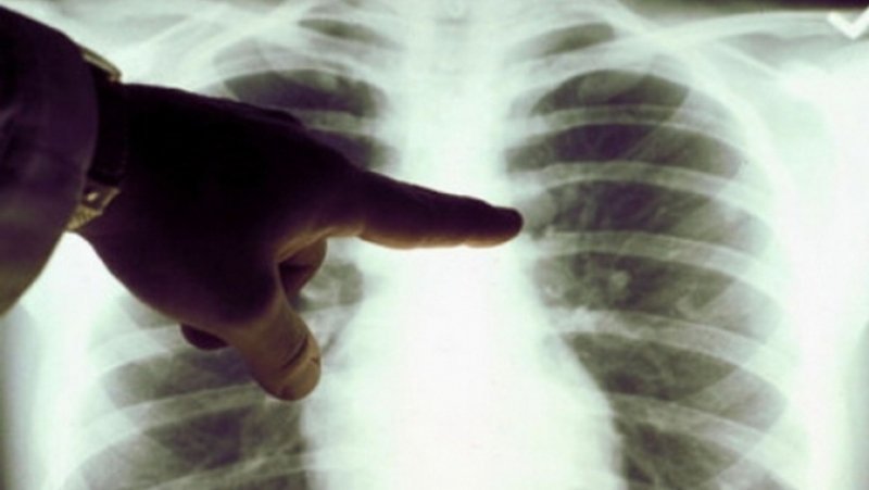 Povestea unui bărbat din Iași, fără probleme de sănătate, care s-a trezit diagnosticat cu TBC