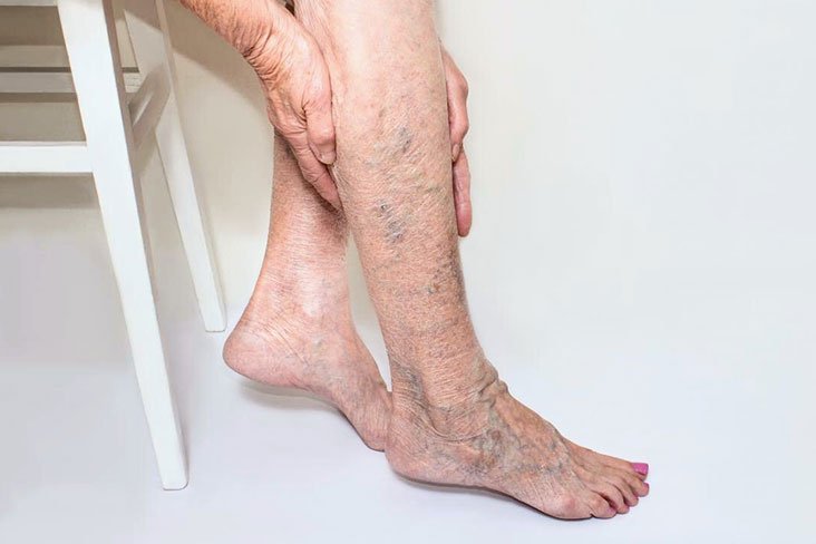  Scleroterapia – metodă de tratament în insuficienţa venoasă cronică