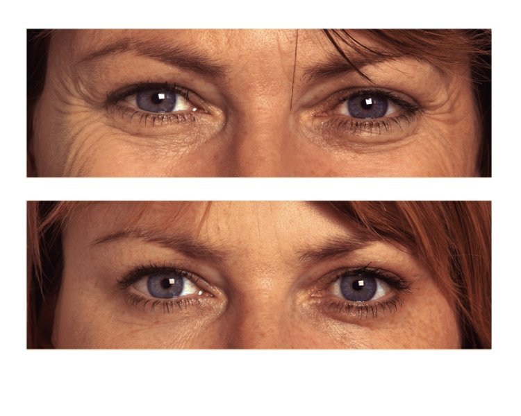 Adio, riduri! O nouă descoperire ne va ajuta să ne menţinem pielea mereu tânără