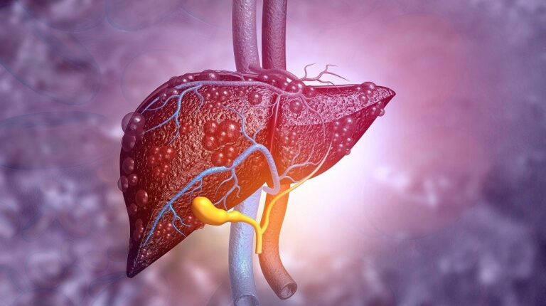 Modificări minore în alimentaţie ar putea preveni o boală comună a ficatului