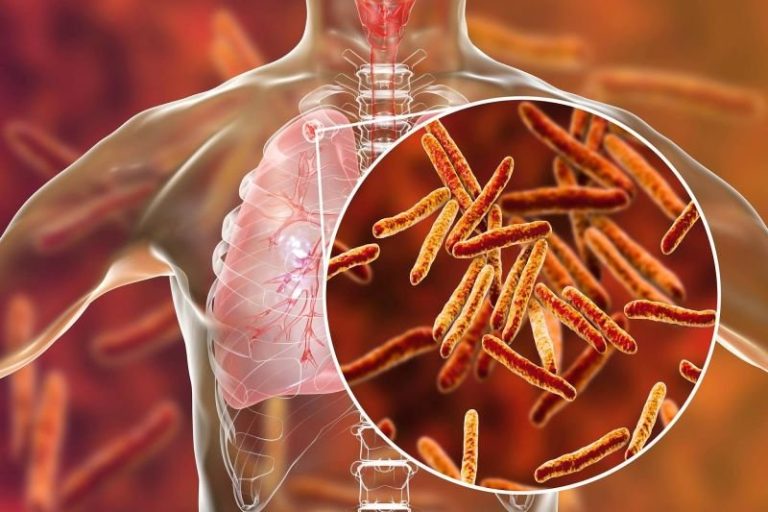 Tuberculoza a redevenit cea mai letală boală infecțioasă din lume