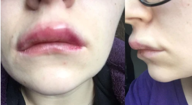 Acidul hialuronic și botoxul, promovate intens pe piața neagră. Riscurile la care se supun pacienții cărora le sunt injectate