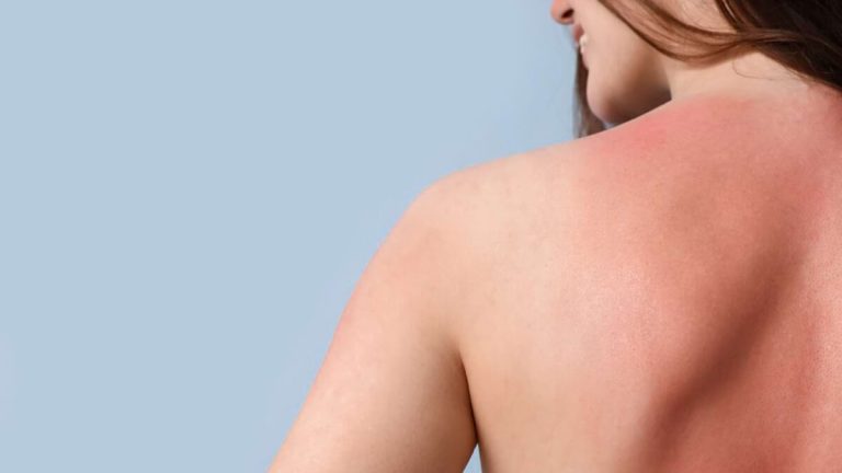 Cum să stai la soare funcție de culoarea părului? Strategii de protecție a pielii: sfarturile dermatologului ieșean Corneliu Dobre