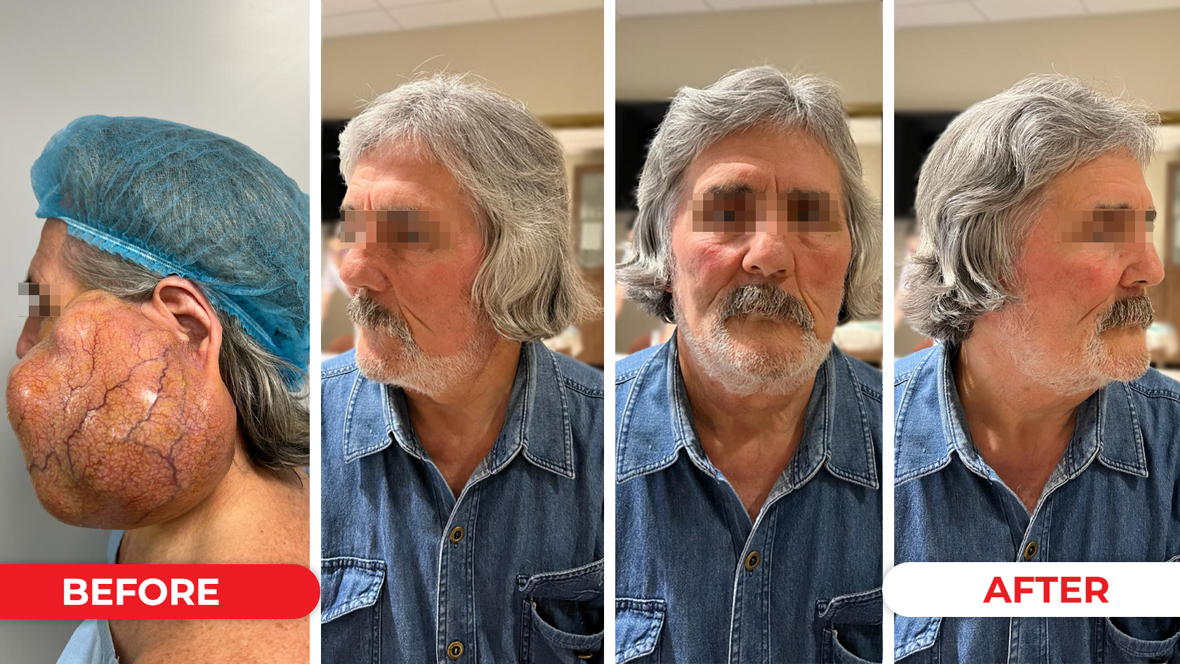 O tumoră facială cu diametru de peste 30 cm și peste 800 de grame, operată în siguranță la Spitalul Arcadia