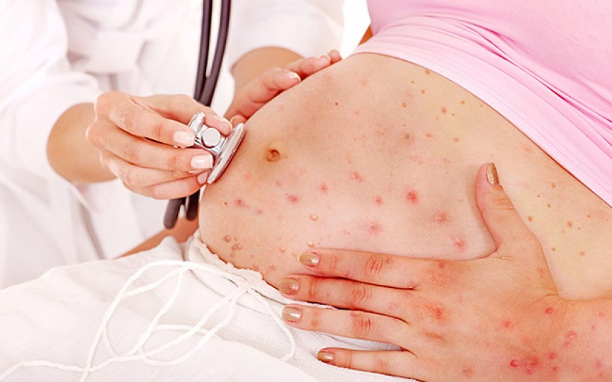 Gravidele nu se pot vaccina împotriva rujeolei, dar pot face un tratament profilactic