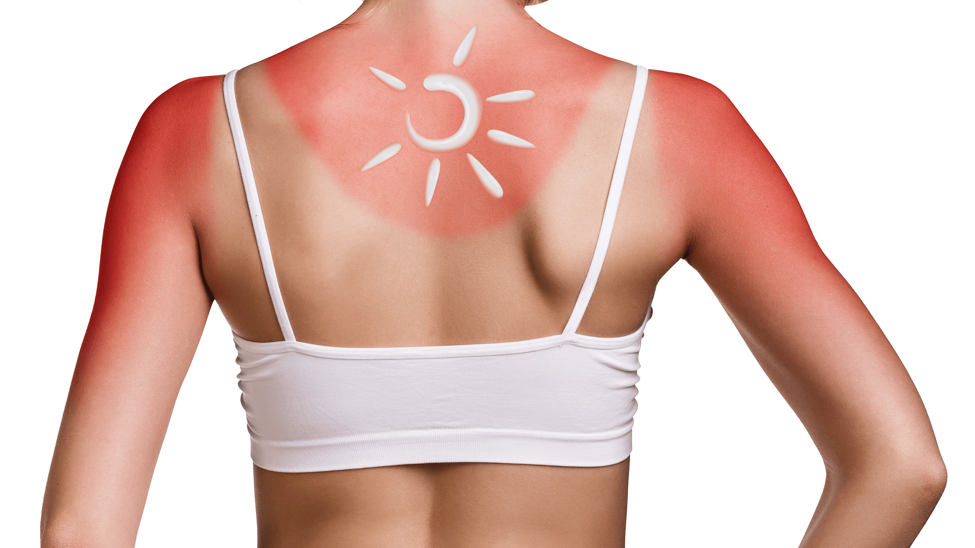 Alergia la soare și arsurile solare