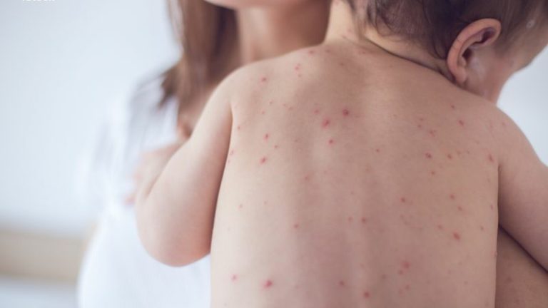 Un bebeluș de opt luni a murit de rujeolă după ce s-a infectat de la membrii familiei