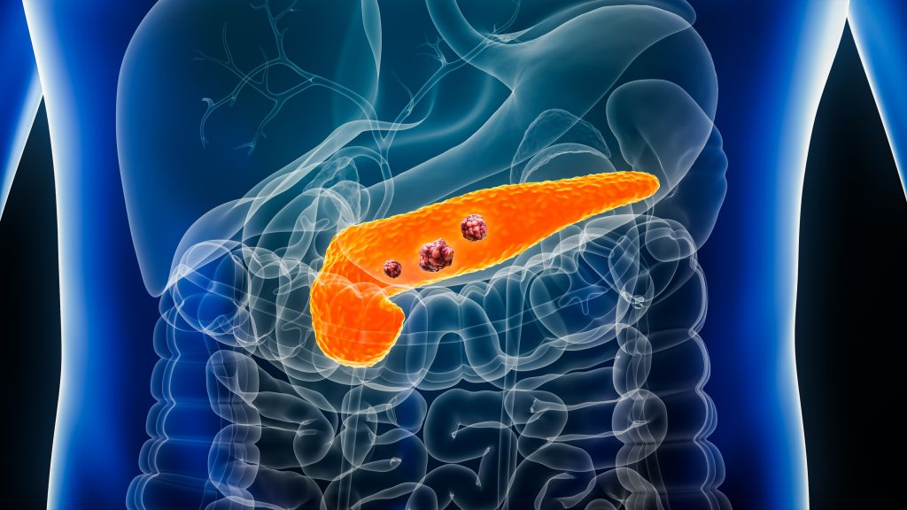 Oamenii de ştiinţă au făcut o descoperire ADN care ar putea contribui la găsirea unui tratament pentru cancerul pancreatic