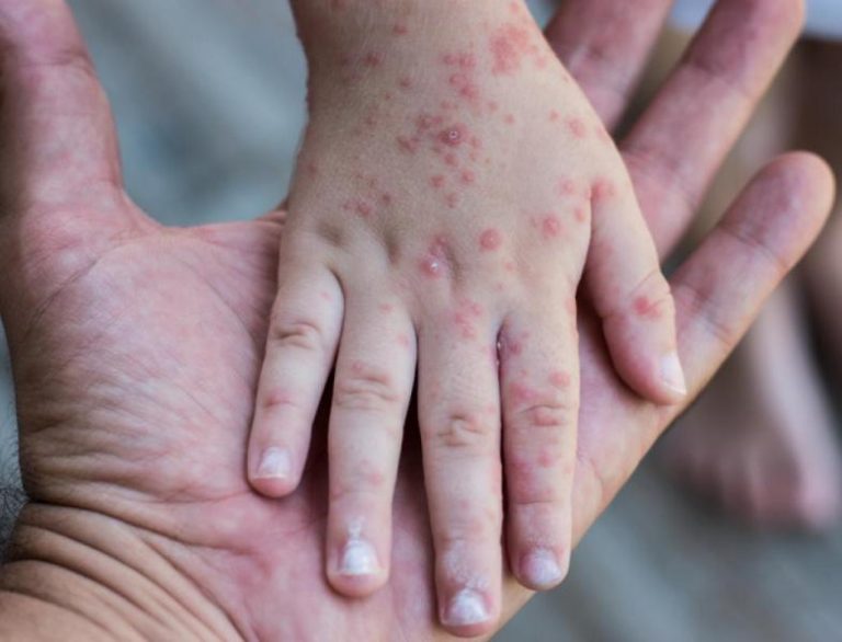 Copil din Iași, ucis de rujeolă: „Acoperirea vaccinală în zonă este foarte mică”