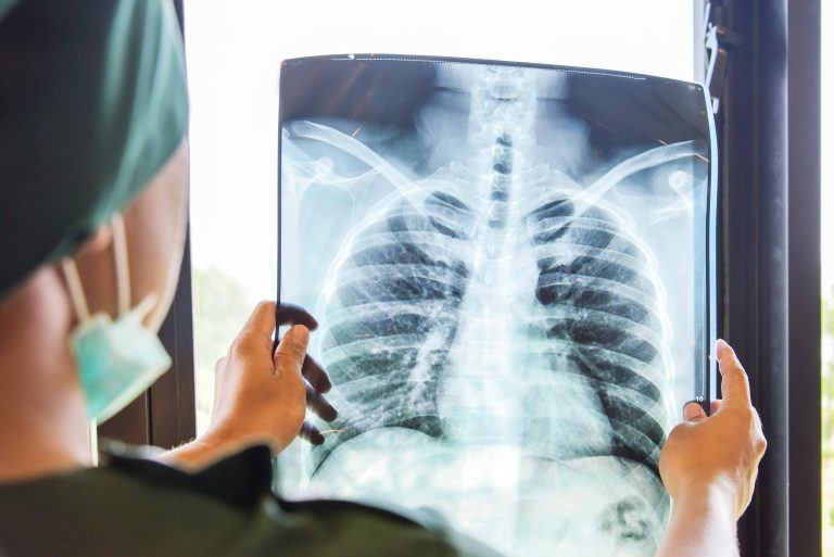 Iașul, județul cu cei mai mulți bolnavi de tuberculoză după București. Câți bani primesc pacienții de la stat pentru tratament?