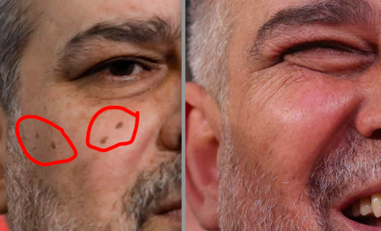 FOTO Ciolacu s-a „tunat” estetic la medici pentru a arăta prezidențiabil: și-a înlăturat câteva alunițe de pe față și și-a schimbat dinții