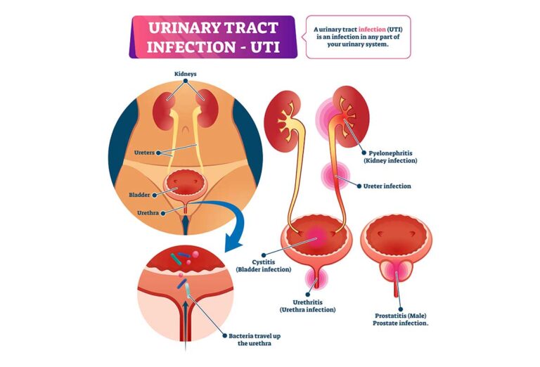 O femeie din două va avea, de-a lungul vieții, cel puțin un episod de infecție urinară