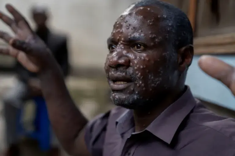 OMS declanşează cel mai înalt nivel de alertă sanitară la nivel internaţional împotriva unei creşteri a cazurilor de mpox în Africa