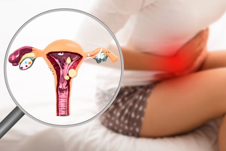 Femeile cu endometrioză prezintă un risc mai mare de infarct și AVC?