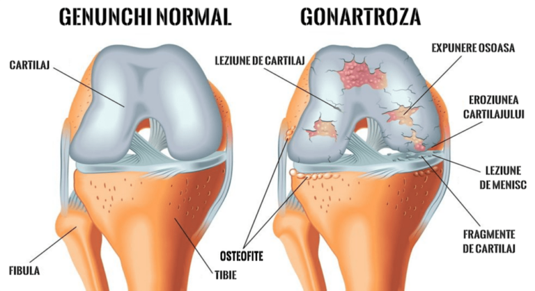 În gonartroză, degradarea cartilajului articular de la nivelul genunchiului este ireversibilă
