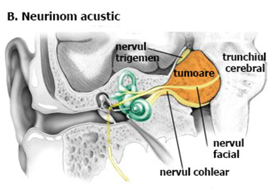 Neurinomul de acustic – o tumoră pe creier frecvent diagnosticată, dar care nu pune viața în pericol