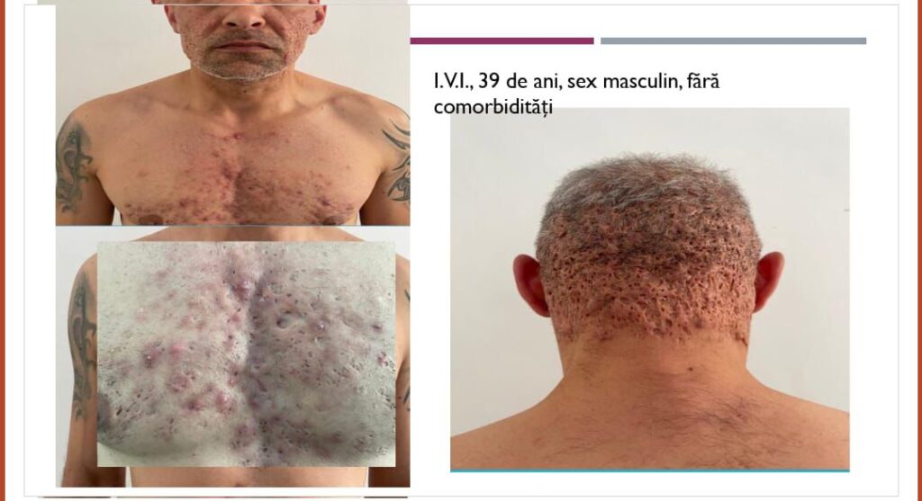  Una din cele mai chinuitoare boli poate fi tratată în premieră la Iași. Bolnavul are scurgeri constante de puroi prin piele