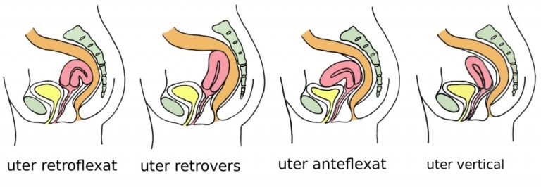 O femeie din cinci are uterul retroversat