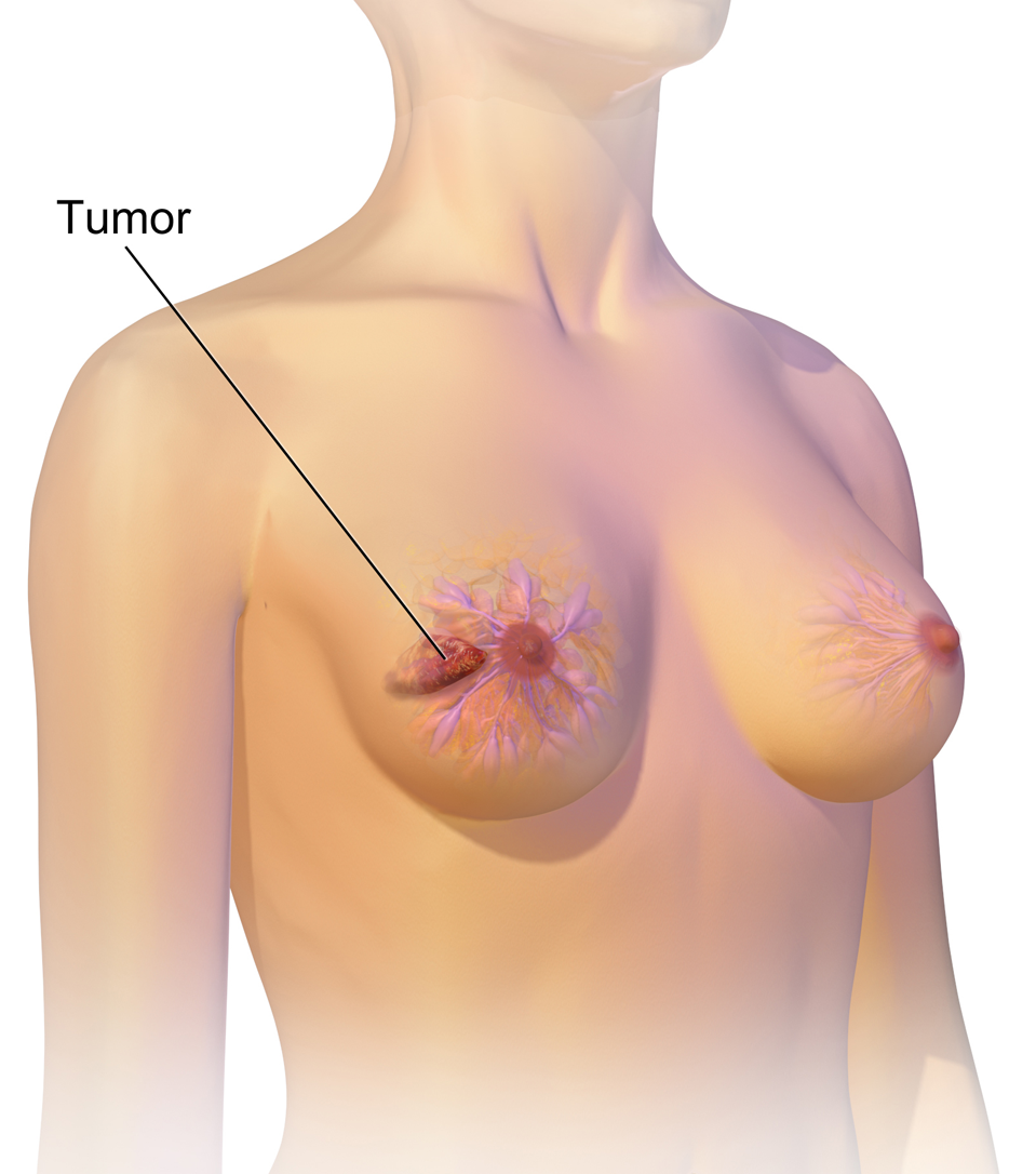 Predispoziția genetică poate crește riscul de metastază a cancerului de sân