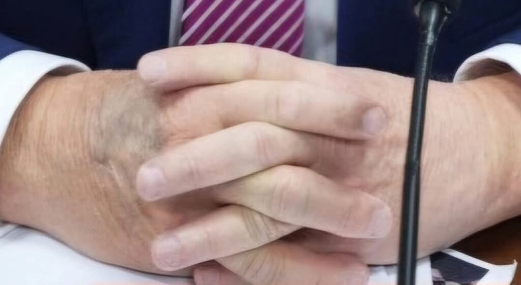  Casa Albă: O vânătaie mare de pe mâna lui Trump  ar fi de la prea multe strângeri de mână