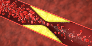 Care sunt valorile normale ale colesterolului în funcție de riscul cardiovascular?