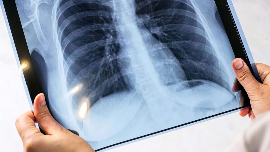 Iașul, pe locul al treilea în țară după numărul de bolnavi de tuberculoză. Peste 250 de pacienți primesc bani ca să facă tratamentul