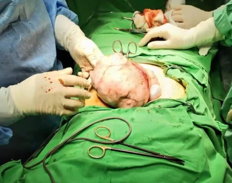 Femeie de 44 de ani, operată pentru o tumoră de 25 cm și 3 kg, crescută în 9 ani: „Din păcate, fără tratament, aceste tumori nu scad” 