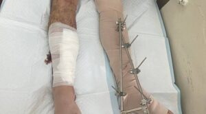 Un campion la înot ucrainean, grav rănit la picioare pe front