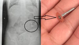 Un dentist din Iași a scăpat în gura unui copil de 5 ani un dispozitiv metalic, iar acesta l-a înghițit.„Plângea mai tare pentru că țipa mama”