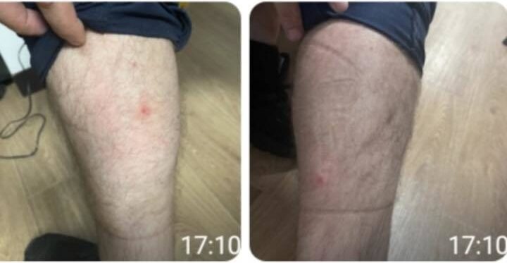  Poliţişti muşcaţi de ploşniţe în sediile Poliţiei Capitalei – Zece persoane au ajuns la Urgenţă 