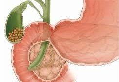 Litiaza veziculară: când așteptăm, când operăm, ne explică medicul Gabriela Canschi