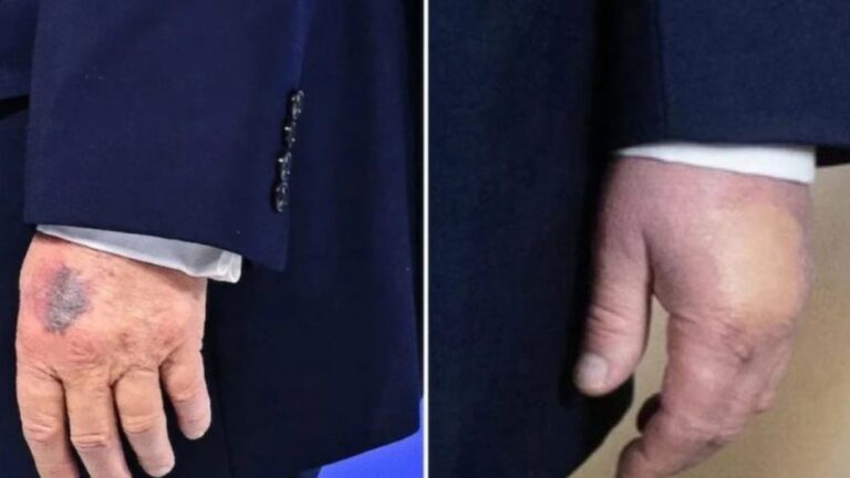 Donald Trump a fost observat la Davos, din nou, cu o vânătaie pe mâna stângă. Explicaţia Casei Albe: s-a lovit de colţul mesei