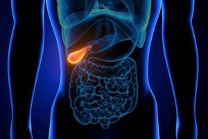 Dr. Gabriela Canschi: pietrele la fiere,o afecțiune tăcută cu complicații zgomotoase